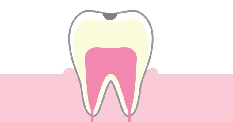 エナメル質に限局した虫歯