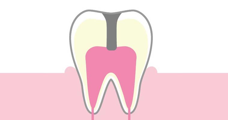 虫歯菌が神経まで及んでいる