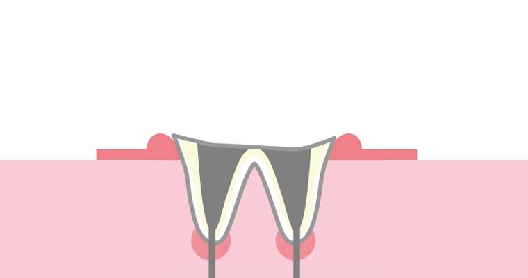 歯冠崩壊・根のみ